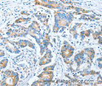 Immunohistochemistry of paraffin-embedded Human colon cancer using IMMT Polyclonal Antibody at dilution of 1:70