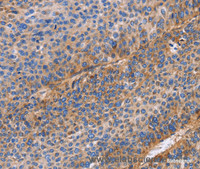Immunohistochemistry of paraffin-embedded Human liver cancer using ITGB1 Polyclonal Antibody at dilution of 1:60