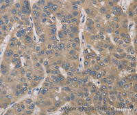 Immunohistochemistry of paraffin-embedded Human liver cancer tissue using IRAK4 Polyclonal Antibody at dilution 1:40