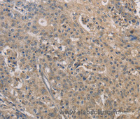 Immunohistochemistry of paraffin-embedded Human gastric cancer tissue using IRAK4 Polyclonal Antibody at dilution 1:40