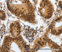 Immunohistochemistry of paraffin-embedded Human colon cancer using COPS5 Polyclonal Antibody at dilution of 1:120
