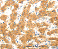 Immunohistochemistry of paraffin-embedded Human liver cancer using MAP2K6 Polyclonal Antibody at dilution of 1:30