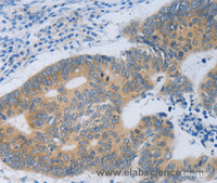 Immunohistochemistry of paraffin-embedded Human colon cancer tissue using MT2A Polyclonal Antibody at dilution 1:40