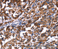 Immunohistochemistry of paraffin-embedded Human thyroid cancer using PHB Polyclonal Antibody at dilution of 1:30