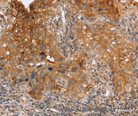 Immunohistochemistry of paraffin-embedded Human cervical cancer using PLAUR Polyclonal Antibody at dilution of 1:60