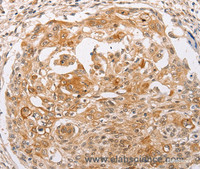 Immunohistochemistry of paraffin-embedded Human cervical cancer using PPP1CB Polyclonal Antibody at dilution of 1:30