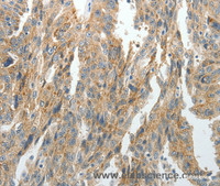 Immunohistochemistry of paraffin-embedded Human ovarian cancer tissue using PRDX5 Polyclonal Antibody at dilution 1:40