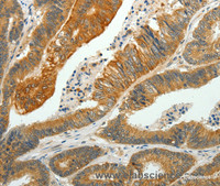 Immunohistochemistry of paraffin-embedded Human colon cancer using SH-PTP1 Polyclonal Antibody at dilution of 1:35