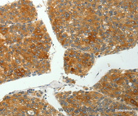 Immunohistochemistry of paraffin-embedded Human liver cancer using SH-PTP1 Polyclonal Antibody at dilution of 1:35