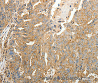 Immunohistochemistry of paraffin-embedded Human ovarian cancer tissue using SFTPD Polyclonal Antibody at dilution 1:30