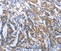 Immunohistochemistry of paraffin-embedded Human colon cancer using SYT17 Polyclonal Antibody at dilution of 1:60