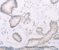 Immunohistochemistry of paraffin-embedded Human colon cancer tissue using MAP3K12 Polyclonal Antibody at dilution 1:30