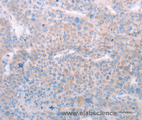 Immunohistochemistry of paraffin-embedded Human liver cancer tissue using SPATA6 Polyclonal Antibody at dilution 1:50