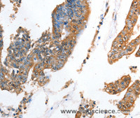 Immunohistochemistry of paraffin-embedded Human colon cancer using AKR1D1 Polyclonal Antibody at dilution of 1:35