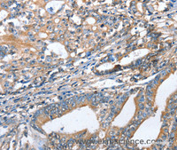 Immunohistochemistry of paraffin-embedded Human gastric cancer using AKR1D1 Polyclonal Antibody at dilution of 1:35