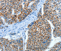 Immunohistochemistry of paraffin-embedded Human liver cancer using ALDH4A1 Polyclonal Antibody at dilution of 1:45