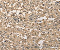 Immunohistochemistry of paraffin-embedded Human thyroid cancer using ALDH8A1 Polyclonal Antibody at dilution of 1:30
