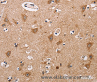 Immunohistochemistry of paraffin-embedded Human thyroid cancer tissue using ALG9 Polyclonal Antibody at dilution 1:60