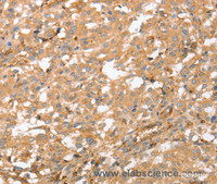 Immunohistochemistry of paraffin-embedded Human thyroid cancer using AHSG Polyclonal Antibody at dilution of 1:60