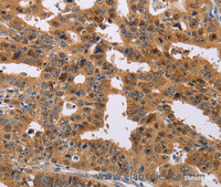 Immunohistochemistry of paraffin-embedded Human gasrtic cancer tissue using NIF3L1 Polyclonal Antibody at dilution 1:30