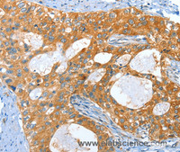 Immunohistochemistry of paraffin-embedded Human cervical cancer tissue using AMHR2 Polyclonal Antibody at dilution 1:40