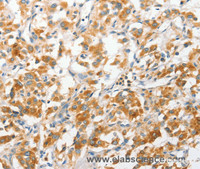 Immunohistochemistry of paraffin-embedded Human thyroid cancer tissue using ANAPC2 Polyclonal Antibody at dilution 1:30