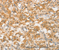 Immunohistochemistry of paraffin-embedded Human thyroid cancer using ATG5 Polyclonal Antibody at dilution of 1:40