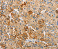 Immunohistochemistry of paraffin-embedded Human liver cancer tissue using APOBEC3G Polyclonal Antibody at dilution 1:50