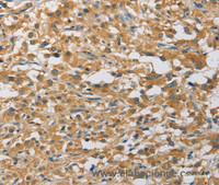 Immunohistochemistry of paraffin-embedded Human thyroid cancer tissue using MIP Polyclonal Antibody at dilution 1:60