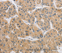 Immunohistochemistry of paraffin-embedded Human liver cancer using ARHGAP15 Polyclonal Antibody at dilution of 1:50