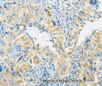 Immunohistochemistry of paraffin-embedded Human cervical cancer tissue using ARHGEF10 Polyclonal Antibody at dilution 1:45