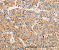 Immunohistochemistry of paraffin-embedded Human liver cancer tissue using ARMCX1 Polyclonal Antibody at dilution 1:40