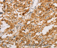 Immunohistochemistry of paraffin-embedded Human thyroid cancer tissue using ARMCX3 Polyclonal Antibody at dilution 1:40