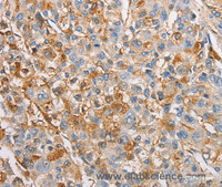 Immunohistochemistry of paraffin-embedded Human liver cancer tissue using IKK gamma Polyclonal Antibody at dilution 1:60