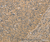 Immunohistochemistry of paraffin-embedded Human cervical cancer tissue using PRDM14 Polyclonal Antibody at dilution 1:30