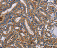 Immunohistochemistry of paraffin-embedded Human thyroid cancer tissue using TLR8 Polyclonal Antibody at dilution 1:40
