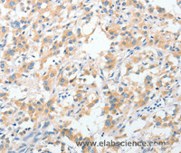 Immunohistochemistry of paraffin-embedded Human thyroid cancer using RPN1 Polyclonal Antibody at dilution of 1:30