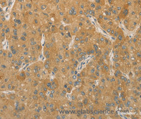 Immunohistochemistry of paraffin-embedded Human liver cancer tissue using PRPSAP1 Polyclonal Antibody at dilution 1:80