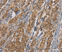 Immunohistochemistry of paraffin-embedded Human gastric cancer tissue using PIKFYVE Polyclonal Antibody at dilution 1:50