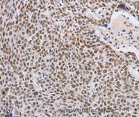 Immunohistochemistry of paraffin-embedded Human lung cancer using THOC7 Polyclonal Antibody at dilution of 1:30