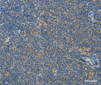 Immunohistochemistry of paraffin-embedded Human lymphoma using ASPA Polyclonal Antibody at dilution of 1:80