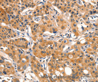 Immunohistochemistry of paraffin-embedded Human lung cancer tissue using AIM2 Polyclonal Antibody at dilution 1:60
