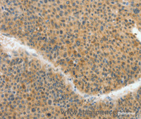 Immunohistochemistry of paraffin-embedded Human liver cancer tissue using ACLY Polyclonal Antibody at dilution 1:40