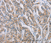Immunohistochemistry of paraffin-embedded Human prostate cancer tissue using ATP2C1 Polyclonal Antibody at dilution 1:50
