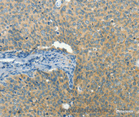 Immunohistochemistry of paraffin-embedded Human cervical cancer tissue using BCAT1 Polyclonal Antibody at dilution 1:50