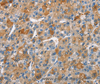 Immunohistochemistry of paraffin-embedded Human liver cancer using BCL10 Polyclonal Antibody at dilution of 1:40