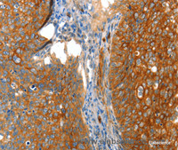 Immunohistochemistry of paraffin-embedded Human cervical cancer tissue using VWA5A Polyclonal Antibody at dilution 1:80