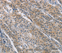 Immunohistochemistry of paraffin-embedded Human gastric cancer using BMP15 Polyclonal Antibody at dilution of 1:40