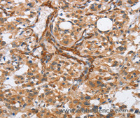 Immunohistochemistry of paraffin-embedded Human thyroid cancer tissue using BUB1 Polyclonal Antibody at dilution 1:50