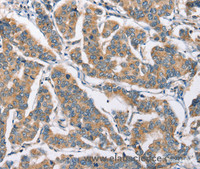 Immunohistochemistry of paraffin-embedded Human breast cancer tissue using CAMK4 Polyclonal Antibody at dilution 1:40